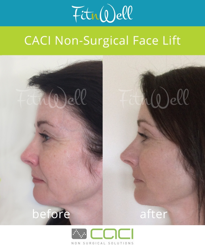 Fit n Well Caci Face Lift - before and after